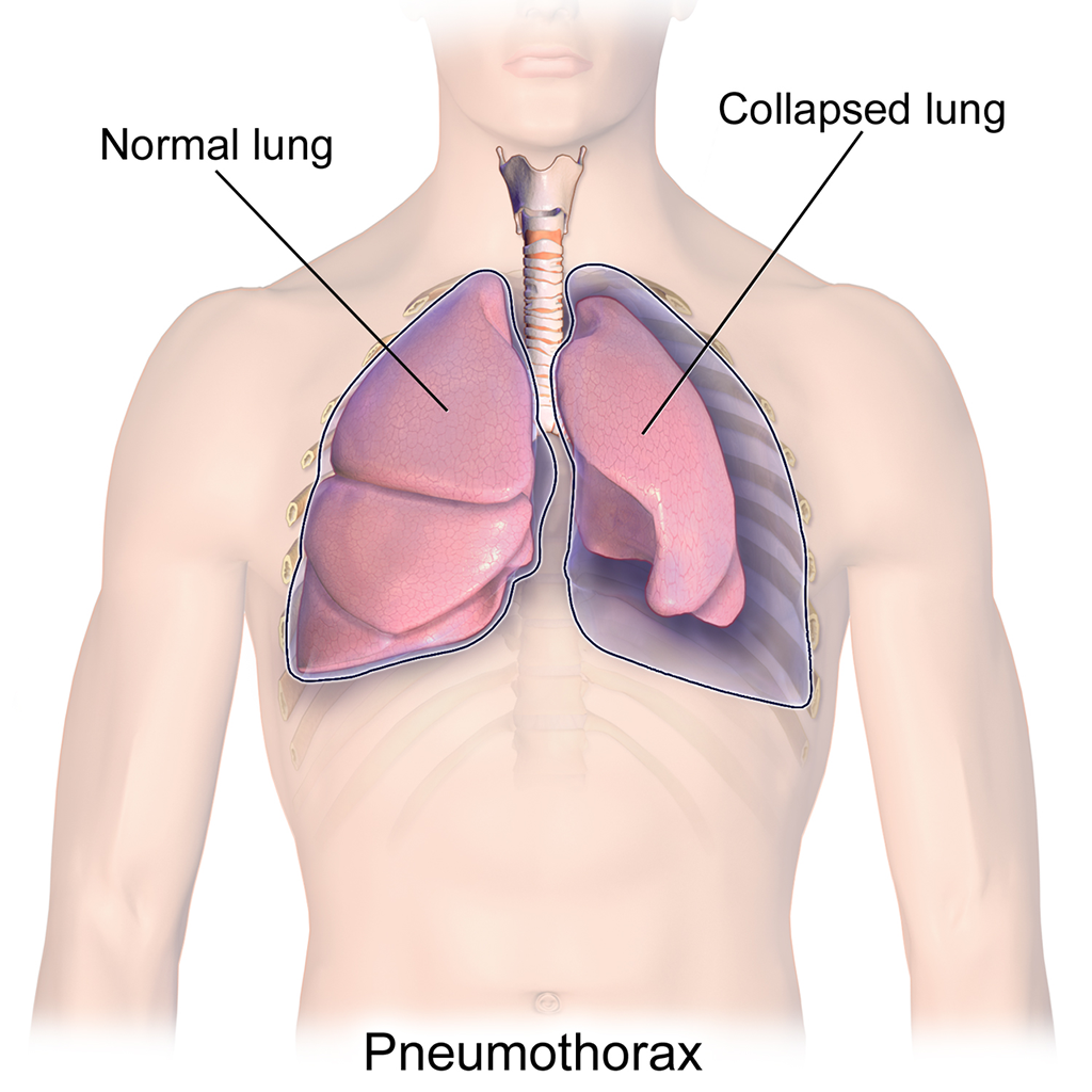 Blausen_0742_Pneumothorax