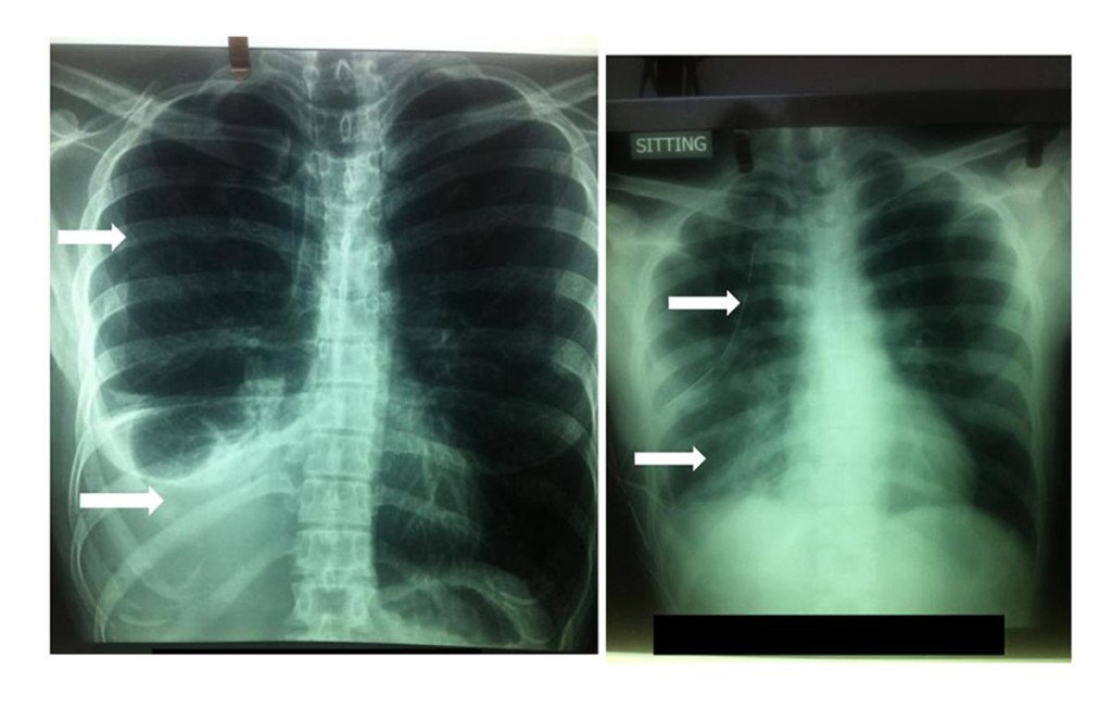 heamothorax